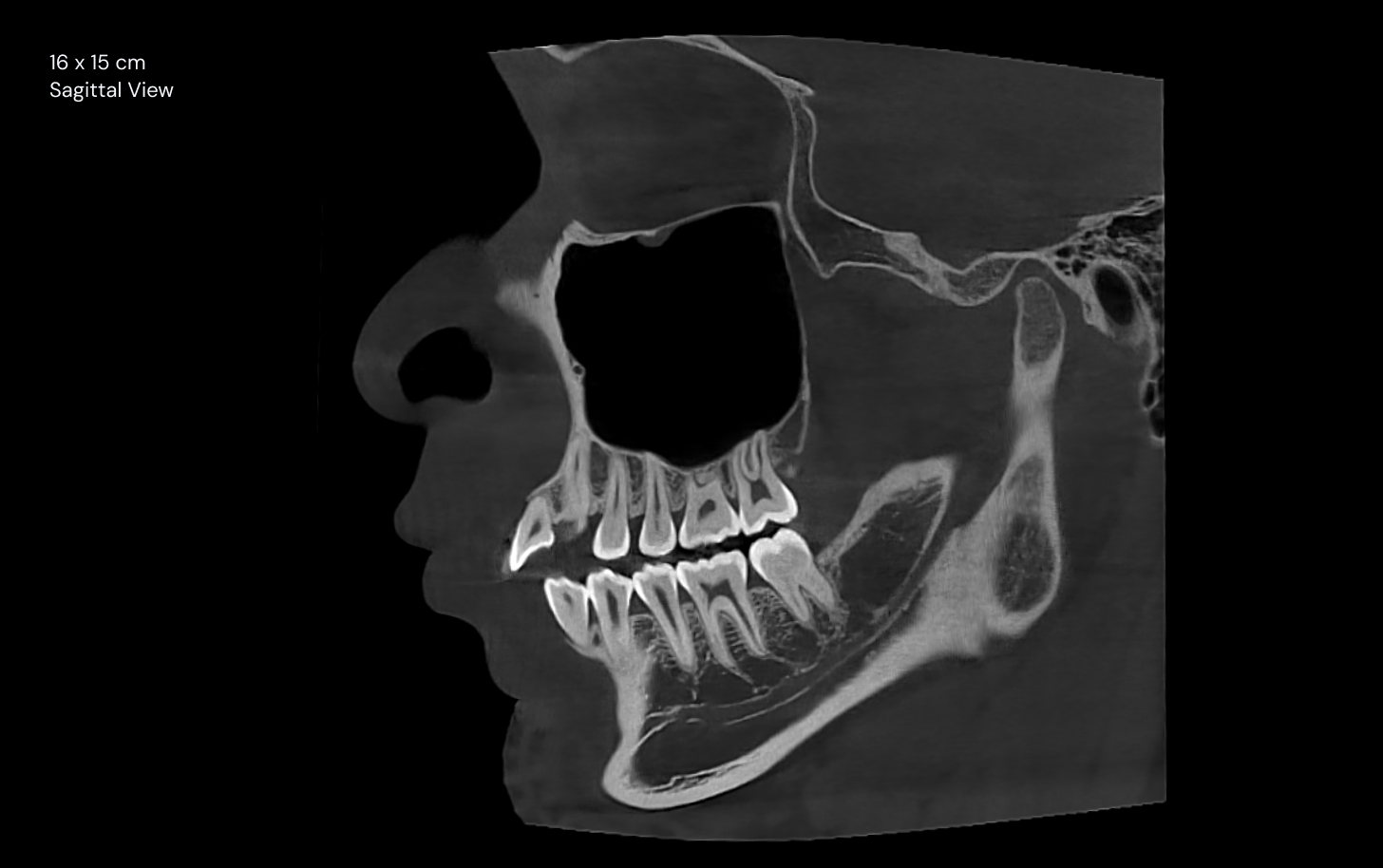 16 x 15 cm Sagittal View